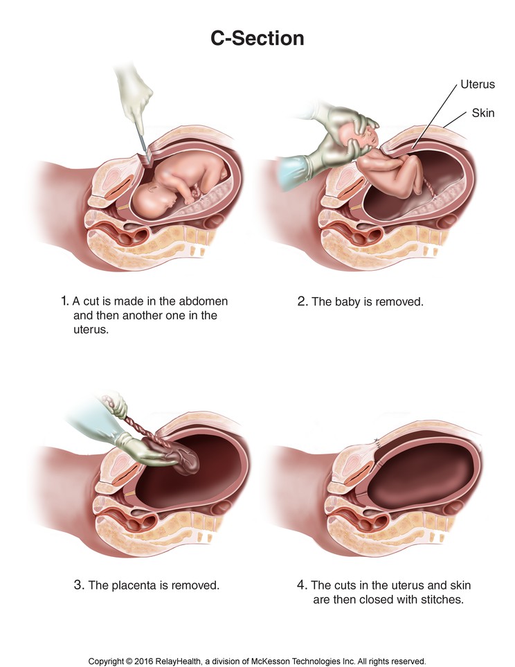 C-Section: Illustration