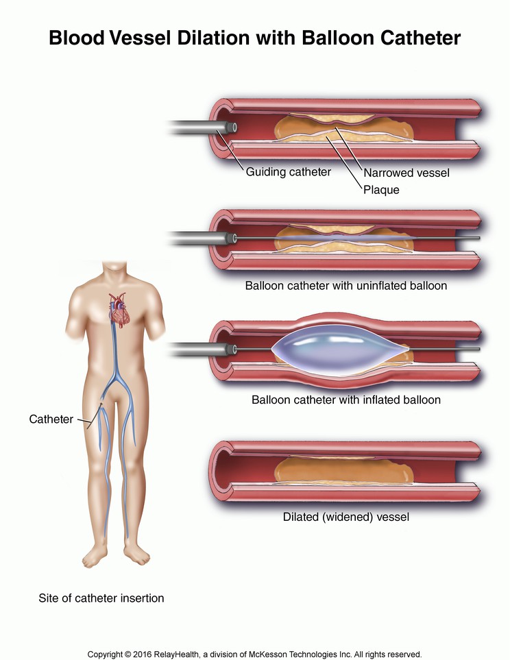 Blood Vessel Dilation with Balloon Catheter: Illustration