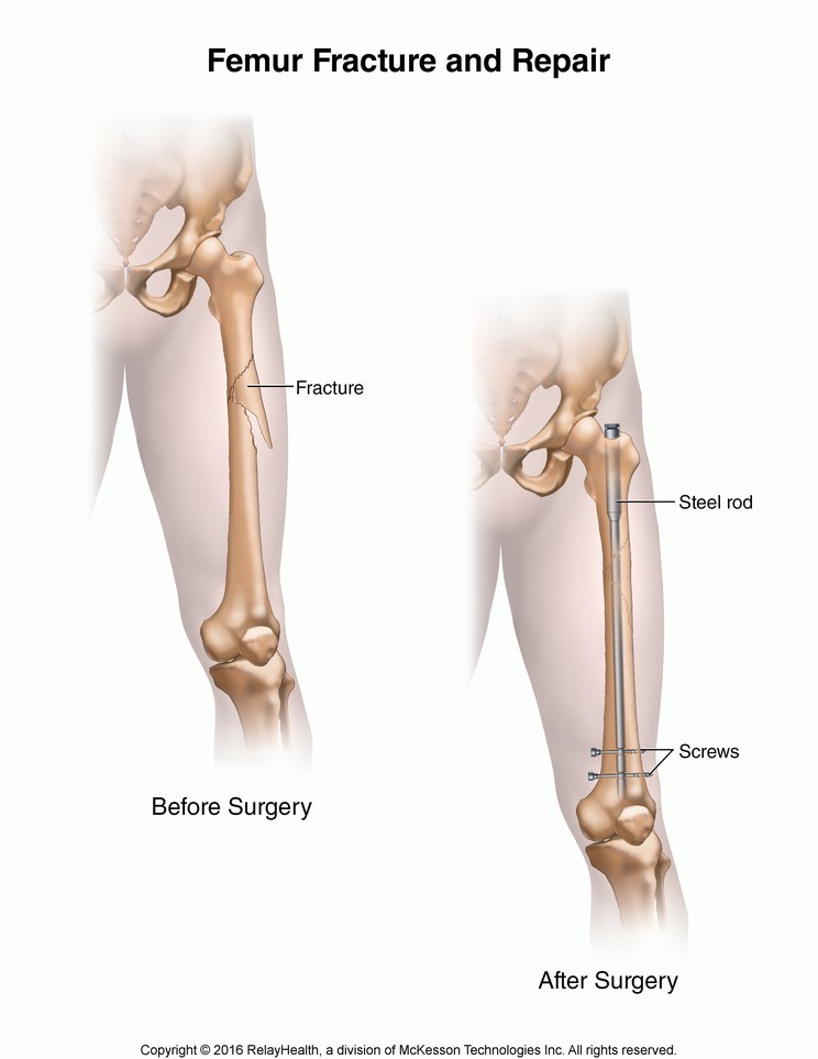 Femur Fracture and Repair: Illustration