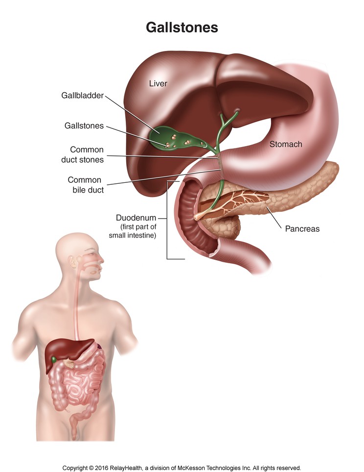 Gallstones: Illustration