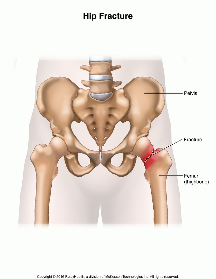 Hip Fracture: Illustration
