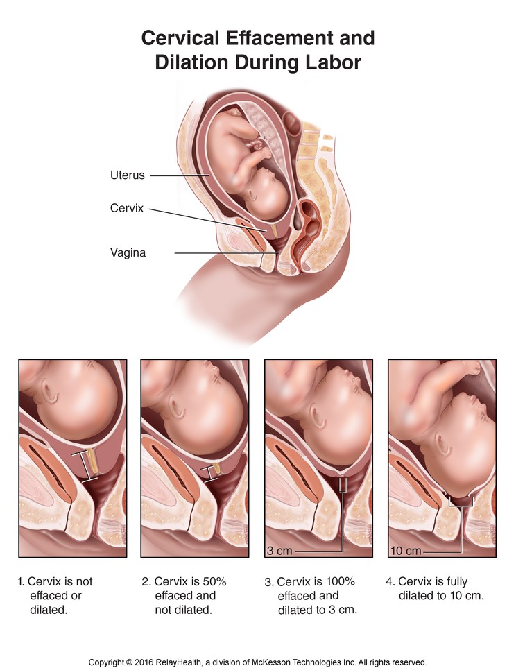 Cervical Effacement and Dilation During Labor: Illustration
