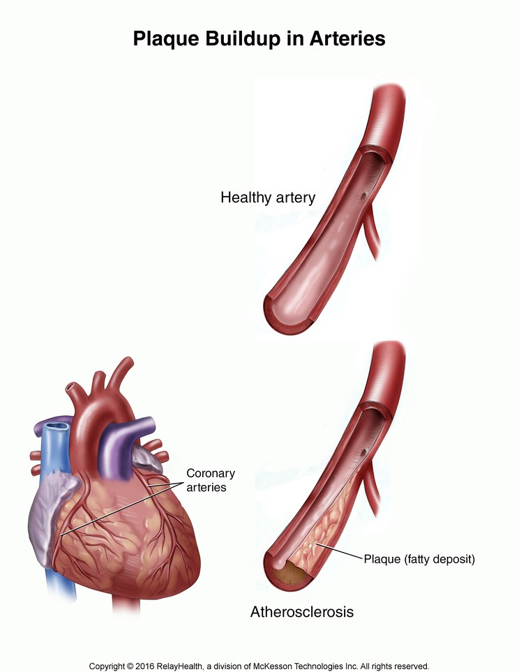 Plaque Buildup in Arteries: Illustration