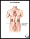 Thumbnail image of: Aortic Aneurysm: Illustration