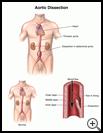 Thumbnail image of: Aortic Dissection: Illustration
