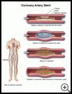 Thumbnail image of: Coronary Artery Stent: Illustration