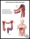 Thumbnail image of: Colonoscopy and Sigmoidoscopy: Illustration