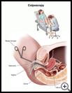 Thumbnail image of: Colposcopy: Illustration