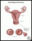 Thumbnail image of: Cone Biopsy of the Cervix: Illustration
