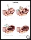 Thumbnail image of: C-Section: Illustration