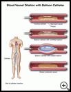 Thumbnail image of: Blood Vessel Dilation with Balloon Catheter: Illustration
