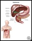 Thumbnail image of: Gallstones: Illustration
