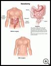 Thumbnail image of: Ileostomy: Illustration