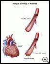 Thumbnail image of: Plaque Buildup in Arteries: Illustration