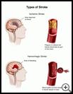 Thumbnail image of: Types of Stroke: Illustration