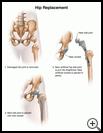 Thumbnail image of: Hip Replacement: Illustration
