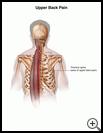 Thumbnail image of: Upper Back Pain: Illustration