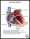 Thumbnail image of: Ventricular Fibrillation: Illustration