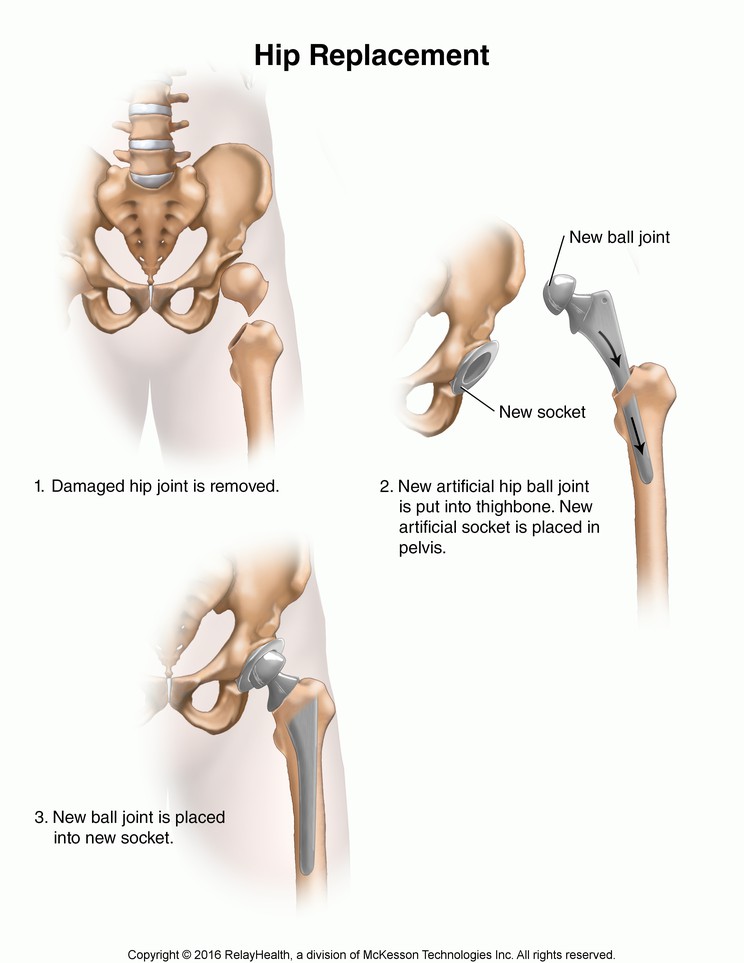 Hip Replacement: Illustration