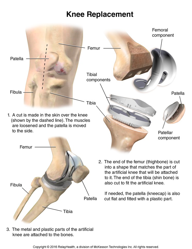 Knee Replacement: Illustration