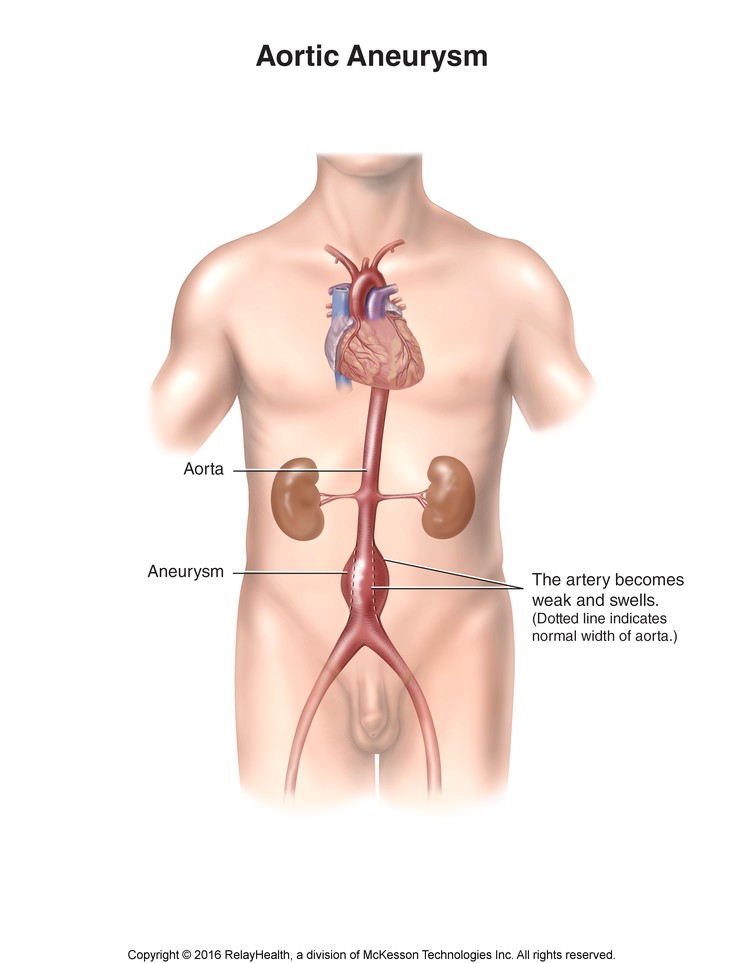 Aortic Aneurysm: Illustration