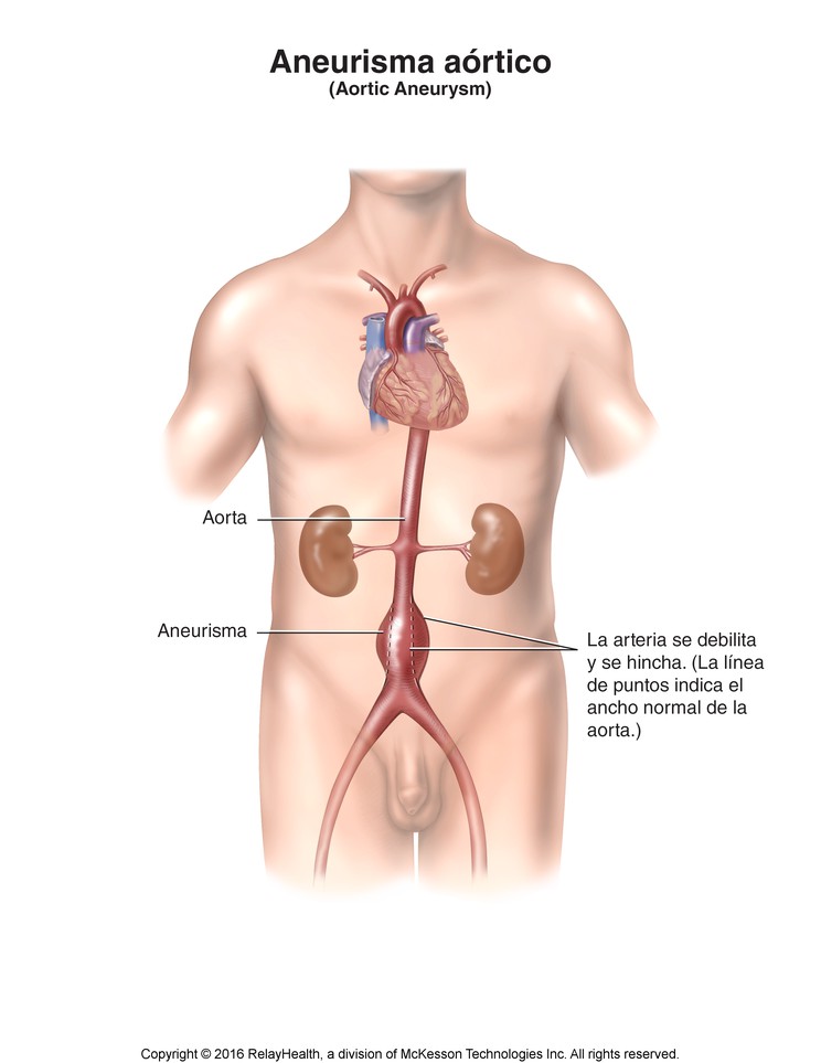 Aortic Aneurysm: Illustration