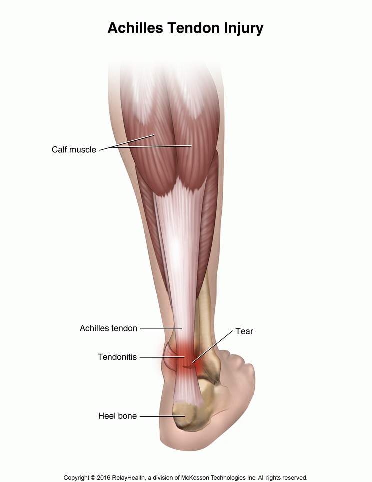 Achilles Tendon Injury: Illustration
