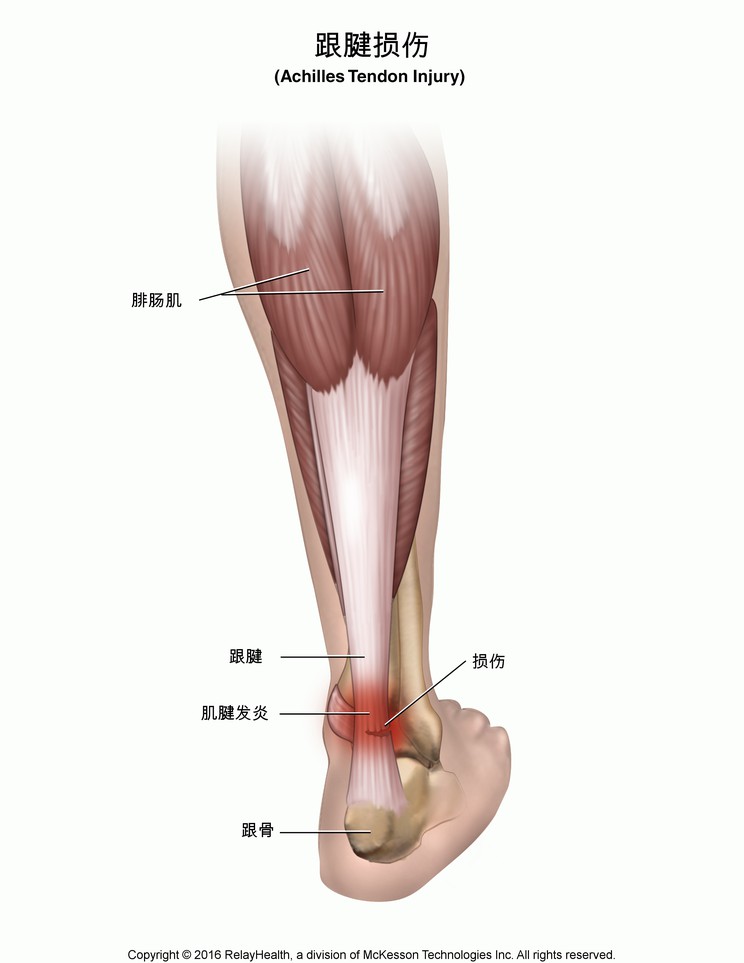 Achilles Tendon Injury: Illustration