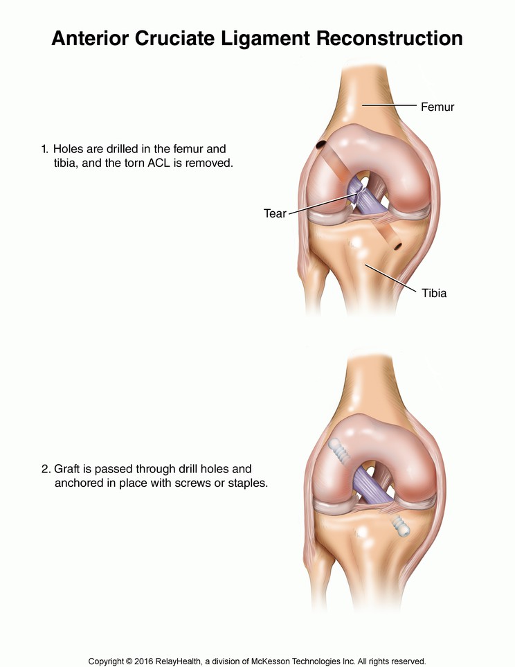 Anterior Cruciate Ligament Reconstruction: Illustration