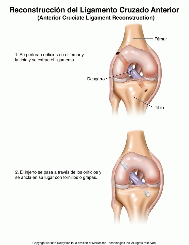 Anterior Cruciate Ligament Reconstruction: Illustration