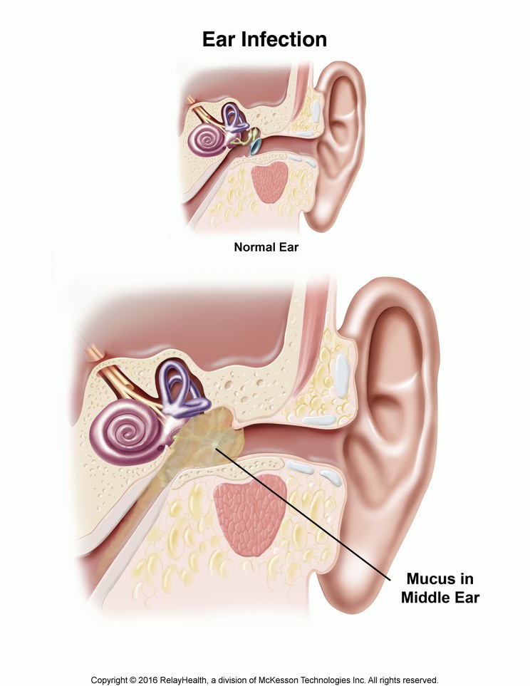 Ear Infection (Otitis Media): Illustration