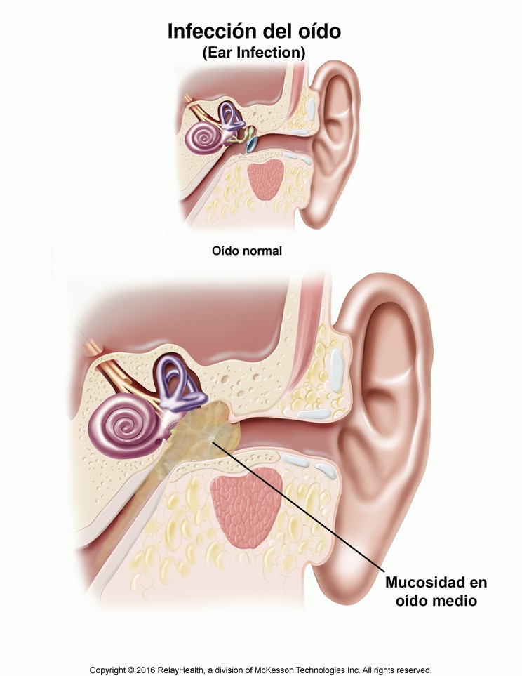 Ear Infection: Illustration