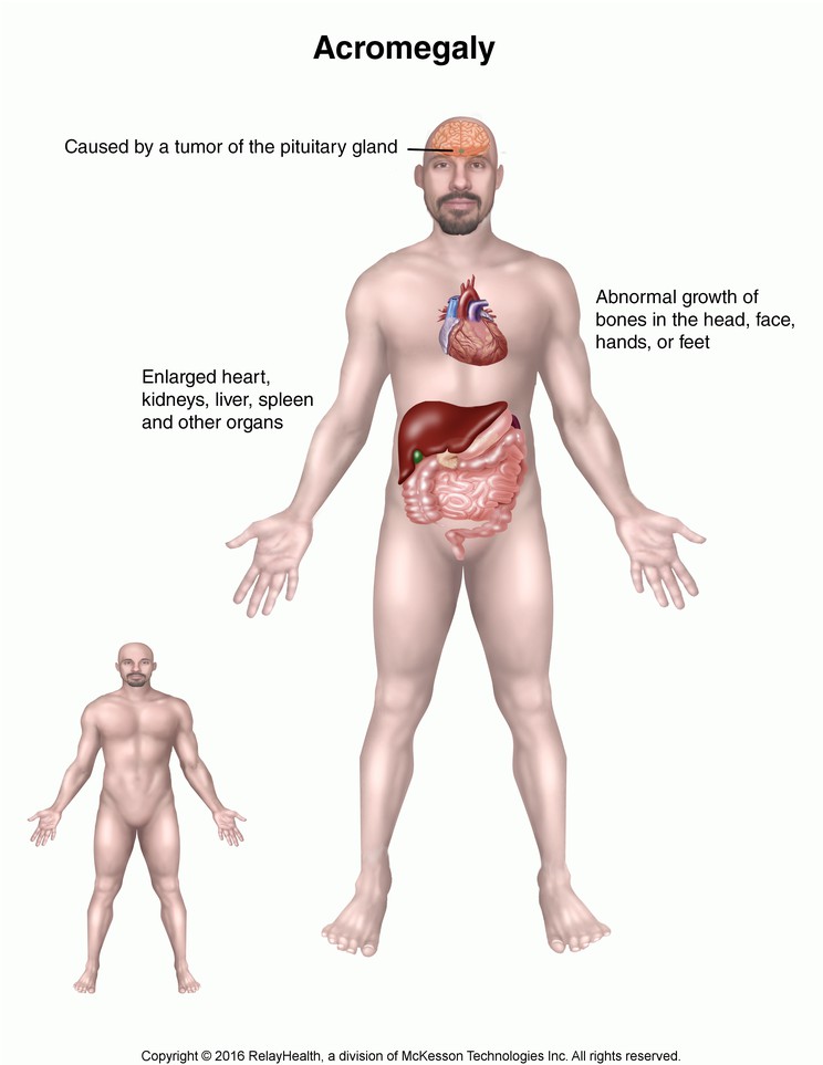 Acromegaly (Excess Growth Hormone): Illustration