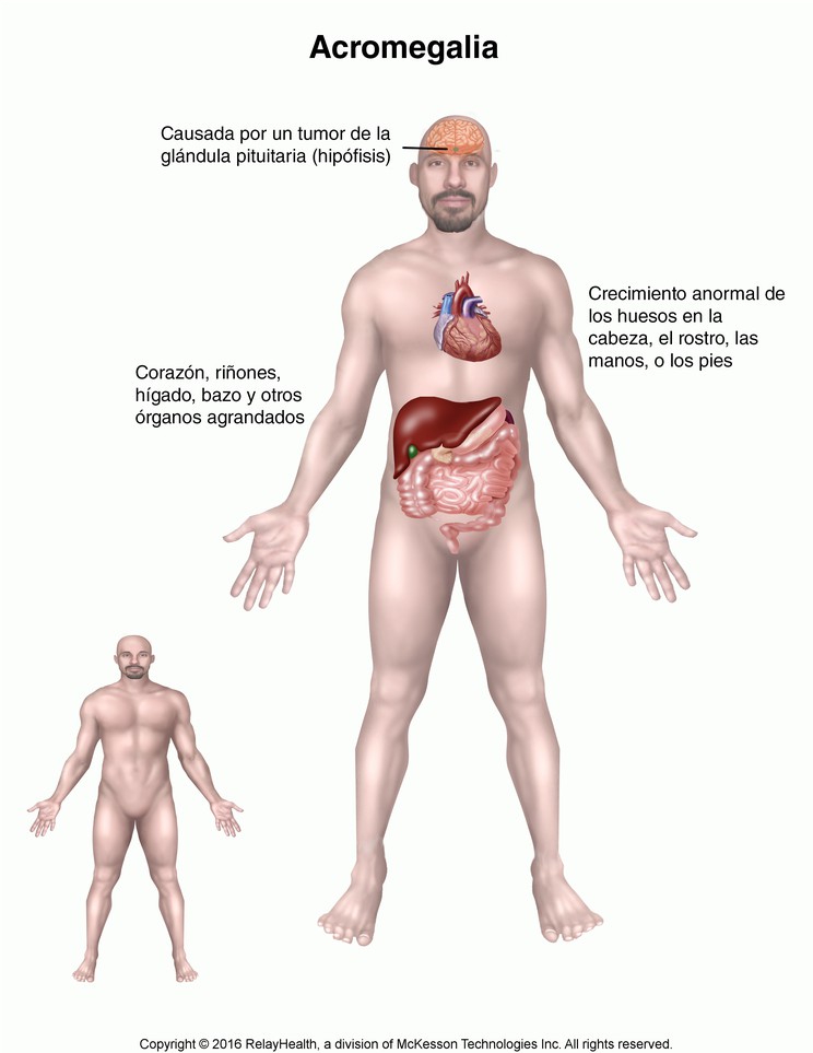 Acromegaly (Excess Growth Hormone): Illustration
