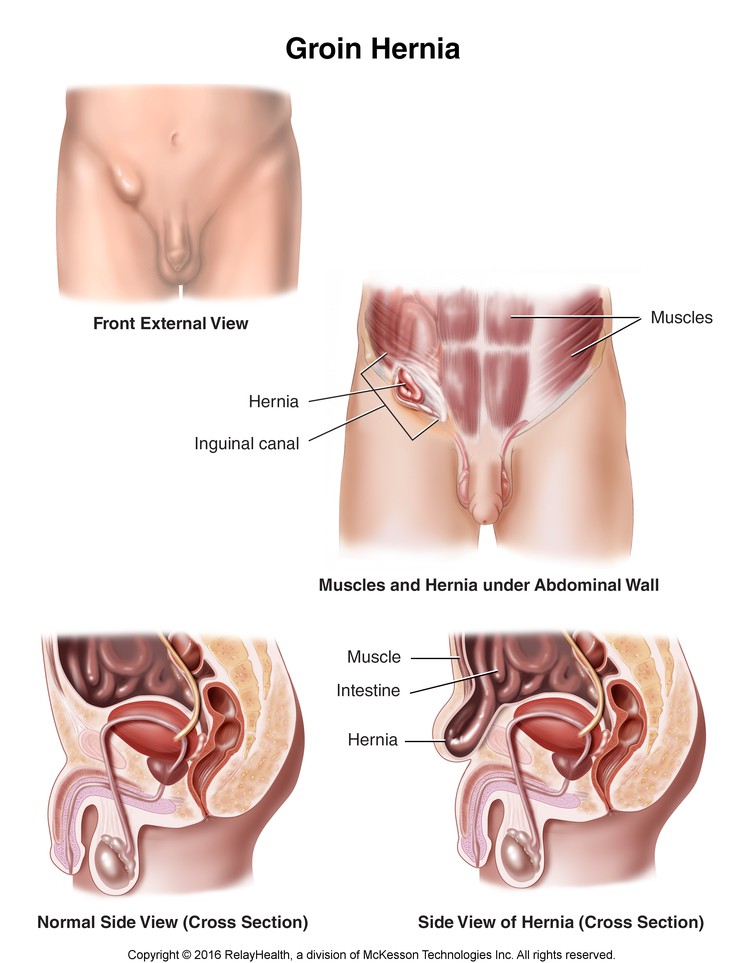 Groin Hernia: Illustration