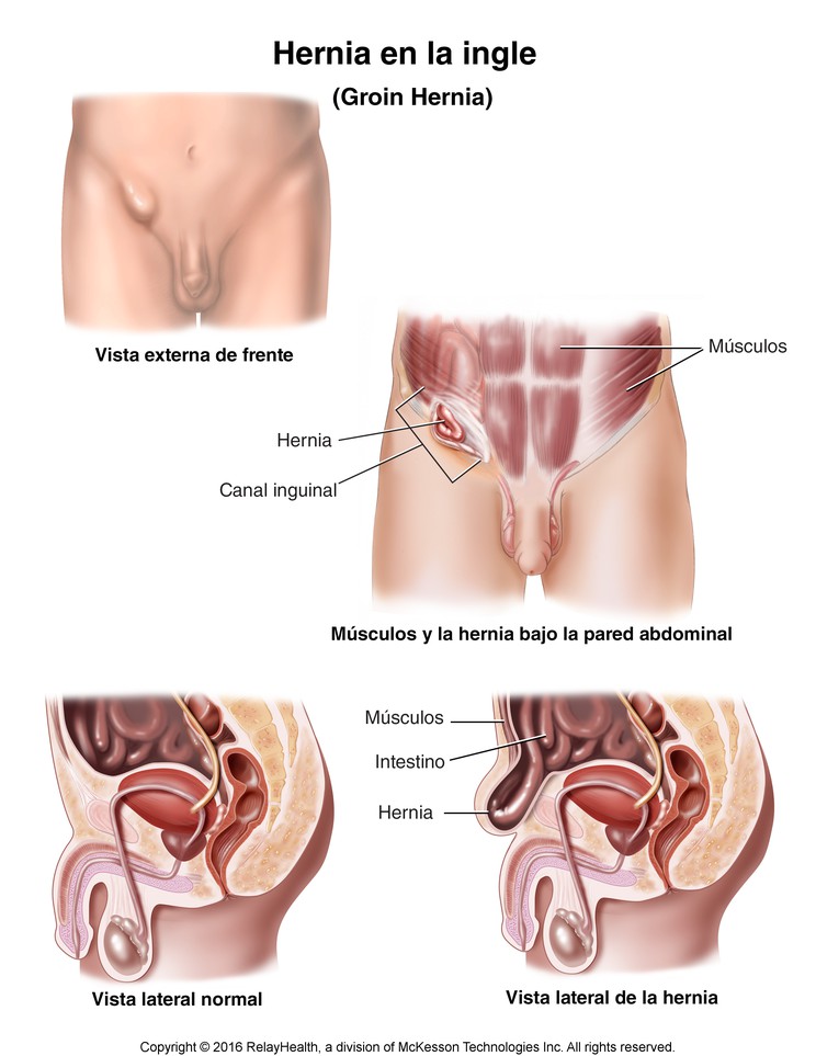 Groin Hernia: Illustration