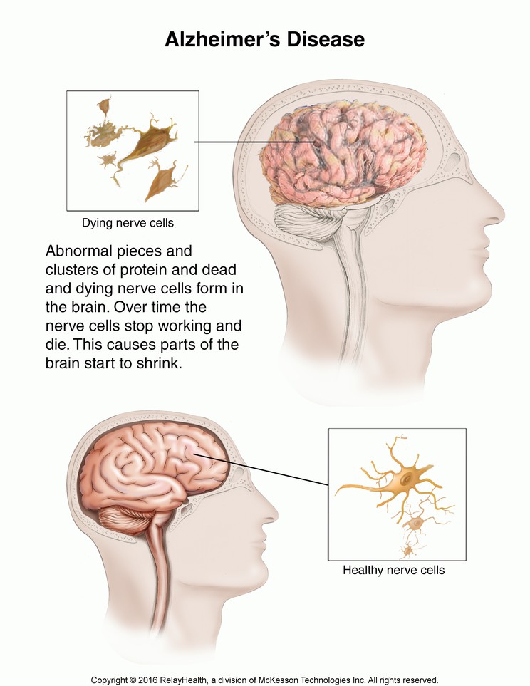 Alzheimer’s Disease: Illustration