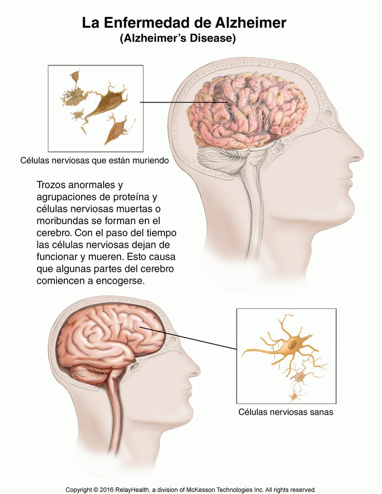 Alzheimer’s Disease: Illustration