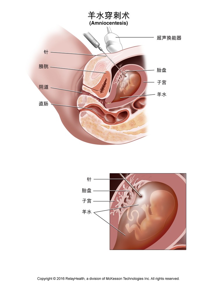 Amniocentesis: Illustration