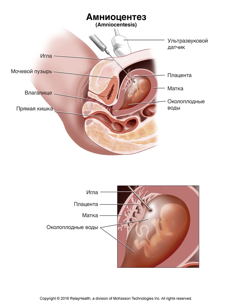 Amniocentesis: Illustration