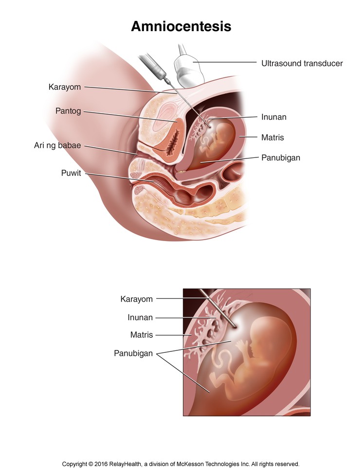 Amniocentesis: Illustration