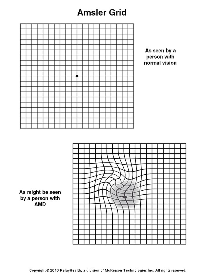 Amsler Grid: Illustration