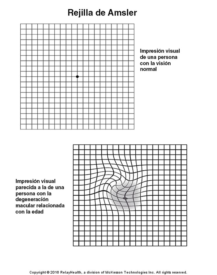 Amsler Grid: Illustration