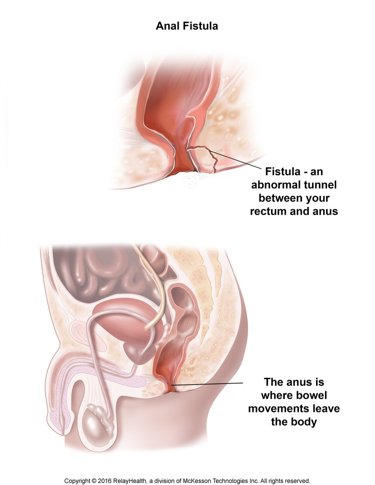 Anal Fistula: Illustration