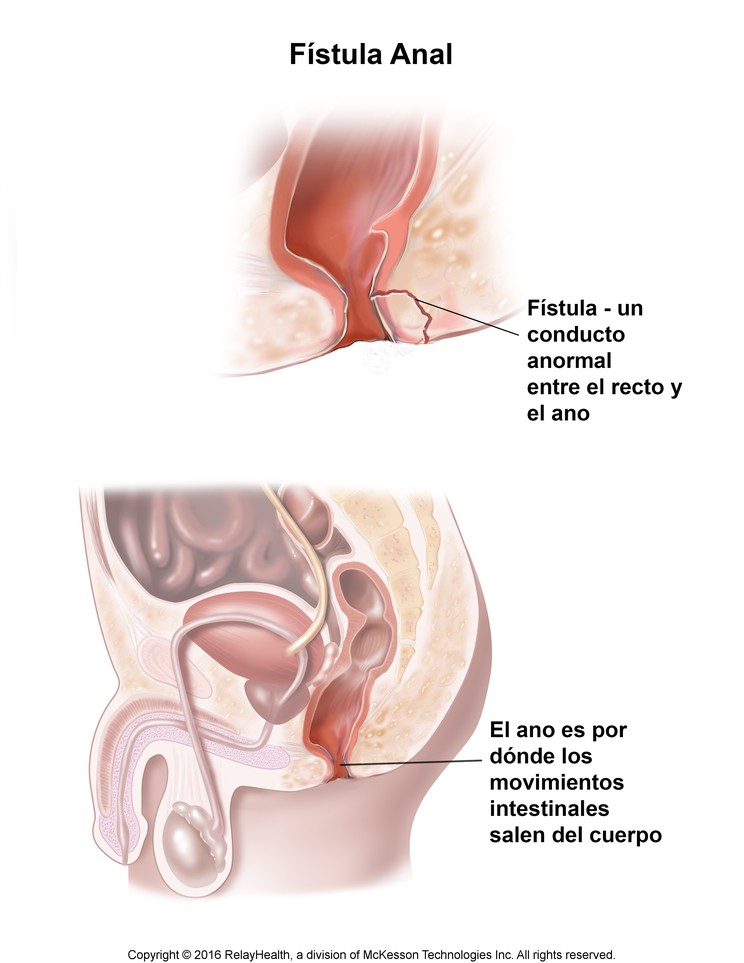 Anal Fistula: Illustration