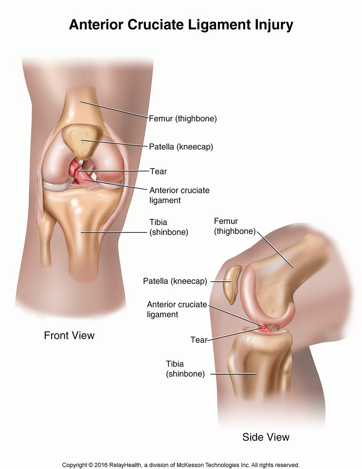 Anterior Cruciate Ligament Injury: Illustration
