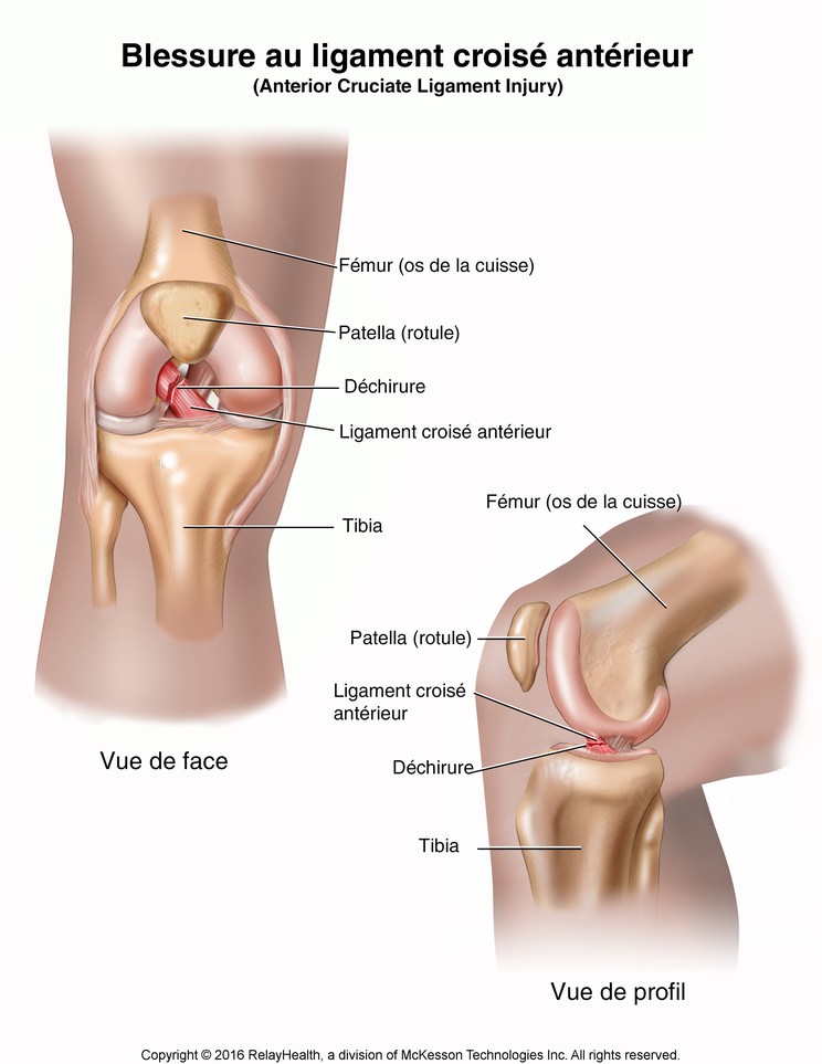 Anterior Cruciate Ligament (ACL) Injury: Illustration