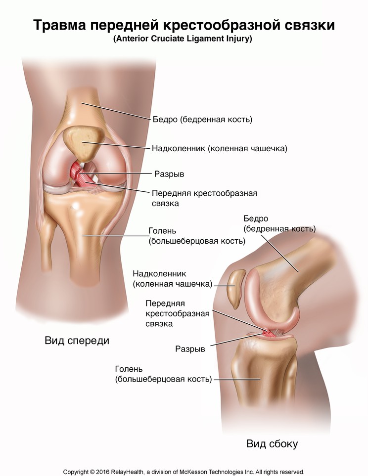 Anterior Cruciate Ligament (ACL) Injury: Illustration