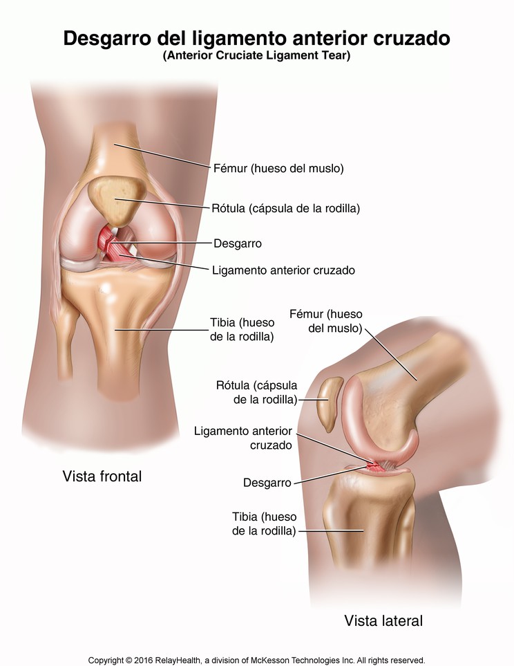 Anterior Cruciate Ligament (ACL) Injury: Illustration