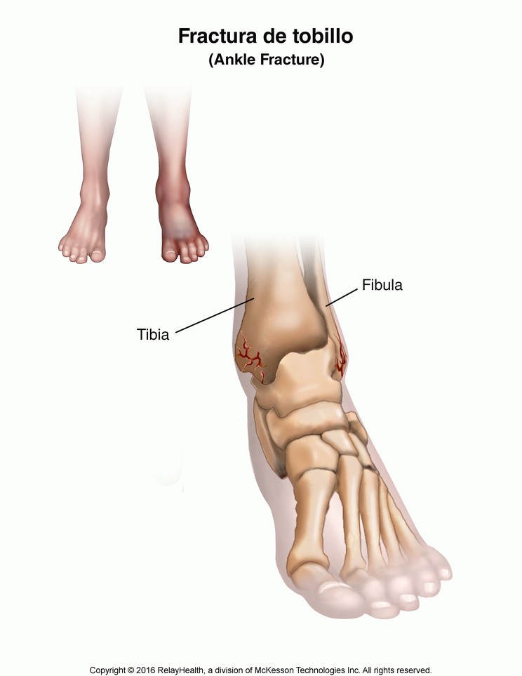 Ankle Fracture: Illustration